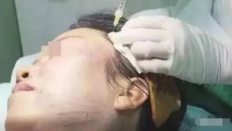 女子线雕手术三年后脸上钻出一根线 女子线雕手术三年后脸上钻出一根线