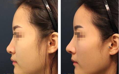 鼻梁高鼻有肉的女人姻缘(鼻梁高的女人婚姻)